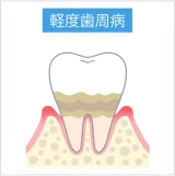 歯垢や歯石が付着し、歯茎がやや下がっている軽度歯周病の状態