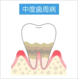 歯槽骨がやや吸収され、炎症が進行している中度歯周病の図