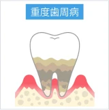 歯槽骨が大きく吸収され、歯茎が大きく後退している重度歯周病の状態