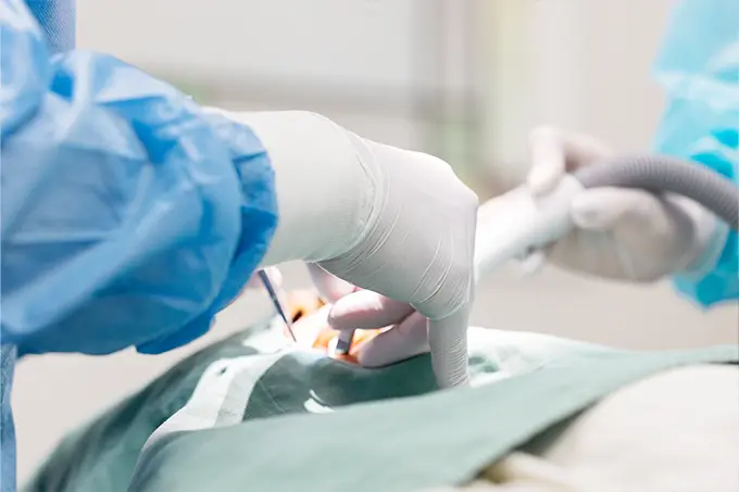 歯科医が手術用手袋とガウンを着用し、患者の口腔内で処置を行っている様子。吸引器も使用中。